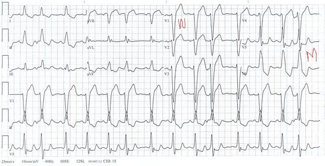 LBBB and RBBB (Right